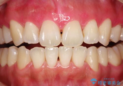 染め出しをしての歯磨き指導とPMTCの治療後