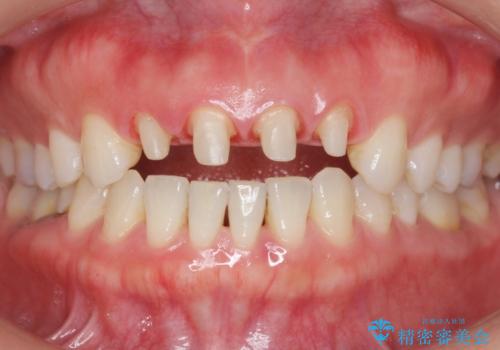 美容外科による不自然なかぶせもので、前歯がコンプレックスに。自然なセラミックにやりかえ 30代女性の治療中