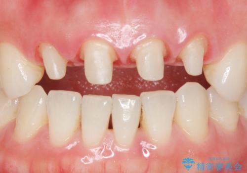 美容外科による不自然なかぶせもので、前歯がコンプレックスに。自然なセラミックにやりかえ 30代女性の治療中