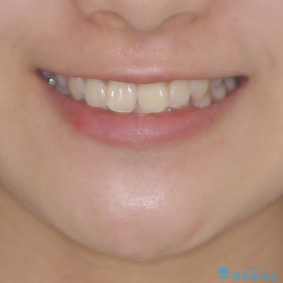 上下前歯の叢生をインビザラインできれいにの治療前（顔貌）
