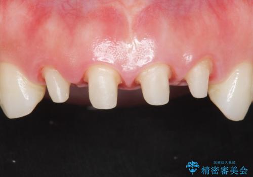美容外科による不自然なかぶせもので、前歯がコンプレックスに。自然なセラミックにやりかえ 30代女性の治療中