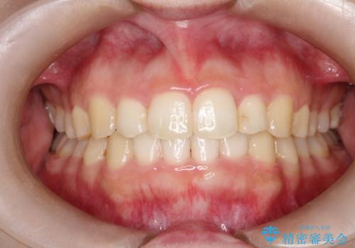 インビザラインでの前歯のガタガタの矯正の症例 治療後