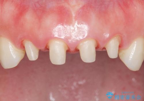 美容外科による不自然なかぶせもので、前歯がコンプレックスに。自然なセラミックにやりかえ 30代女性の治療中