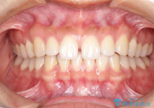 すきっ歯のインビザラインによる目立たない矯正の治療前