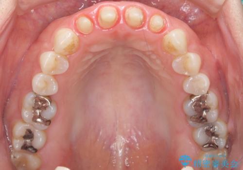 美容外科による不自然なかぶせもので、前歯がコンプレックスに。自然なセラミックにやりかえ 30代女性の治療中