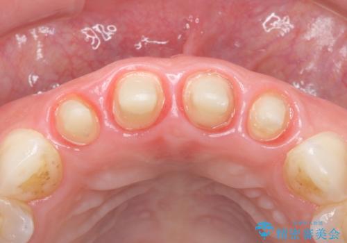 美容外科による不自然なかぶせもので、前歯がコンプレックスに。自然なセラミックにやりかえ 30代女性の治療中