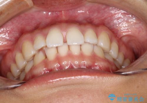 すきっ歯のインビザラインによる目立たない矯正の治療前
