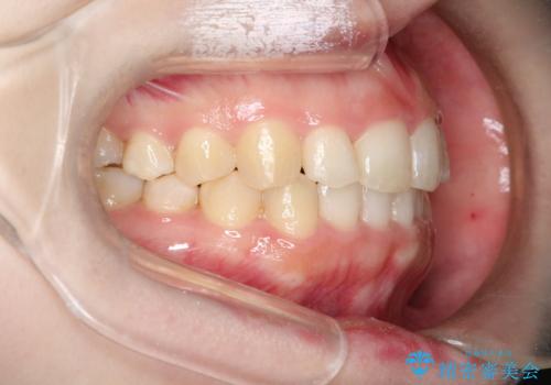 インビザラインでの前歯のガタガタの矯正の治療後