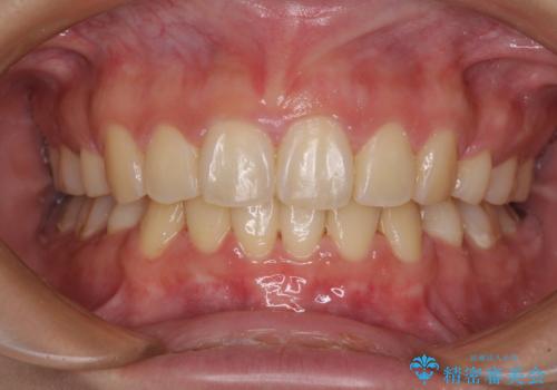 部分矯正で出っ歯になった　出っ歯改善の抜歯矯正