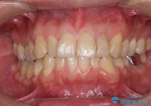 前歯のデコボコと下顎の八重歯 インビザラインによる矯正治療の症例 治療前