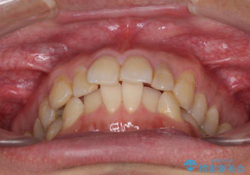 前歯のデコボコと下顎の八重歯 インビザラインによる矯正治療の治療前