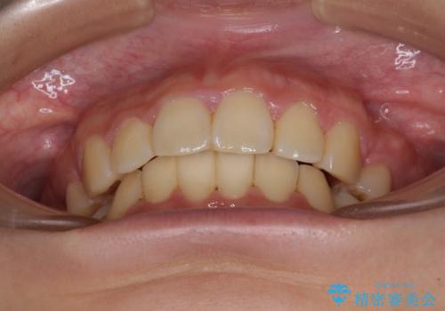 部分矯正で出っ歯になった 出っ歯改善の抜歯矯正の治療後