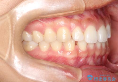 すきっ歯のインビザラインによる目立たない矯正の治療前