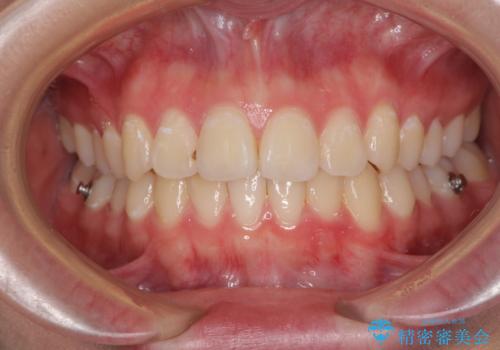 前歯のデコボコを改善　インビザライン矯正の治療中