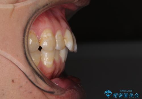 前歯のデコボコと下顎の八重歯　インビザラインによる矯正治療の治療前