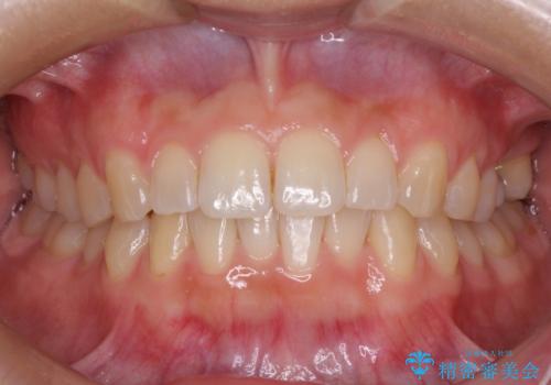 インプラントによる補綴治療とインビザライン矯正の治療中