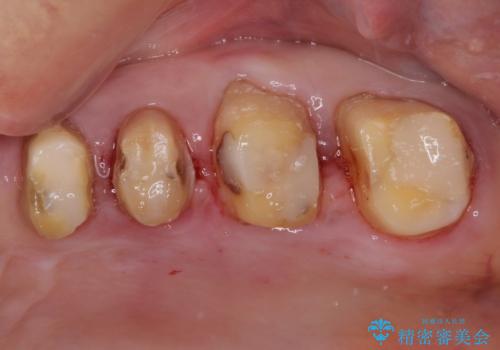 歯肉が腫れて出血する　奥歯の歯周病治療の治療中