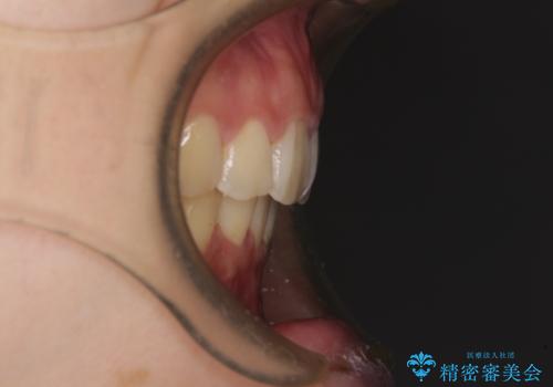 部分矯正で出っ歯になった 出っ歯改善の抜歯矯正の治療後