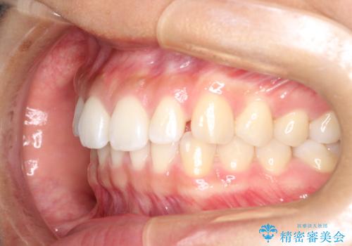 すきっ歯のインビザラインによる目立たない矯正の治療前
