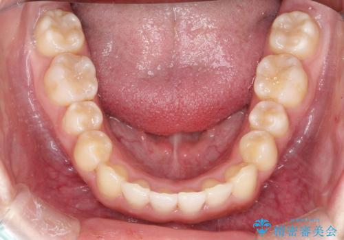 インビザラインでの前歯のガタガタの矯正の治療後