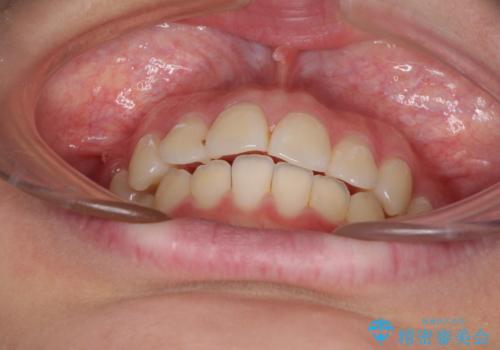 前歯のデコボコを改善 インビザライン矯正の治療中