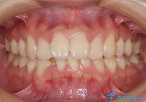 上下前歯の叢生をインビザラインできれいにの症例 治療前