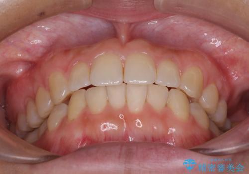 インプラントによる補綴治療とインビザライン矯正の治療中