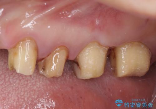 歯肉が腫れて出血する　奥歯の歯周病治療の治療前