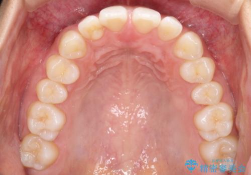 すきっ歯のインビザラインによる目立たない矯正の治療前
