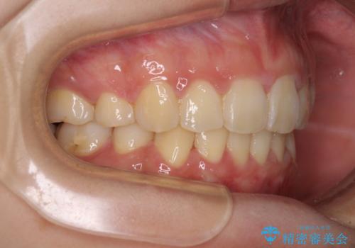 部分矯正で出っ歯になった 出っ歯改善の抜歯矯正の治療後