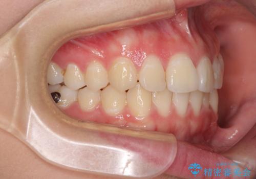 前歯のデコボコを改善　インビザライン矯正の治療中