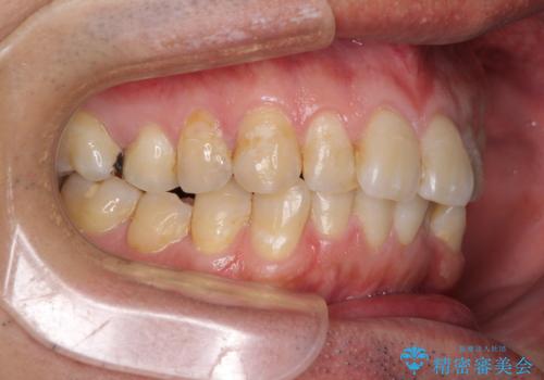 前歯のデコボコと下顎の八重歯 インビザラインによる矯正治療の治療前