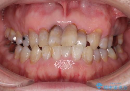 上顎の狭窄歯列 インビザラインによる拡大矯正の治療前