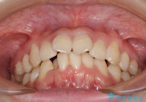 上下前歯の叢生をインビザラインできれいにの治療前