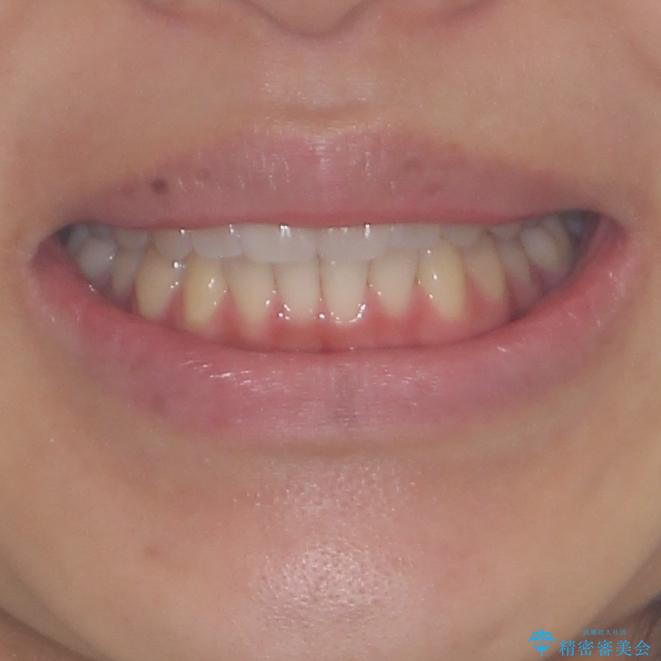 インプラントによる補綴治療とインビザライン矯正の治療後(顔貌)
