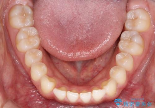 すきっ歯のインビザラインによる目立たない矯正の治療前