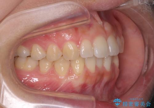 インプラントによる補綴治療とインビザライン矯正の治療中