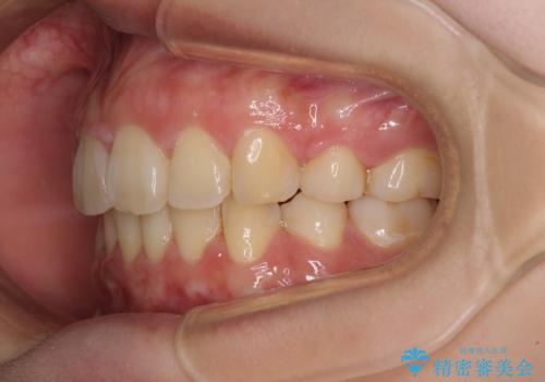 部分矯正で出っ歯になった 出っ歯改善の抜歯矯正の治療後