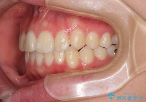前歯のデコボコを改善 インビザライン矯正の治療中