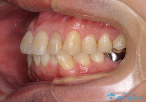 前歯のデコボコと下顎の八重歯 インビザラインによる矯正治療の治療前