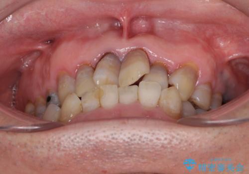 上顎の狭窄歯列　インビザラインによる拡大矯正の治療前