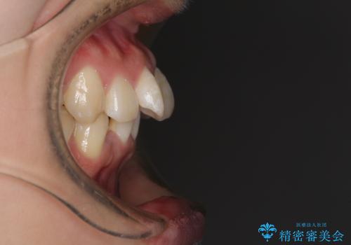 上下前歯の叢生をインビザラインできれいにの治療前