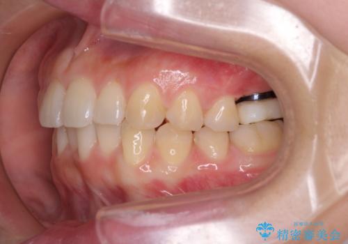 インプラントによる補綴治療とインビザライン矯正の治療中