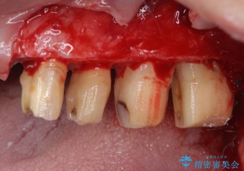 歯肉が腫れて出血する 奥歯の歯周病治療の治療中