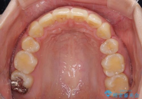 部分矯正で出っ歯になった　出っ歯改善の抜歯矯正の治療後