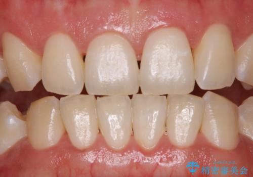 ホワイトニングせずにPMTCで明るい口元にの治療前