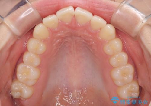 前歯のデコボコを改善 インビザライン矯正の治療中