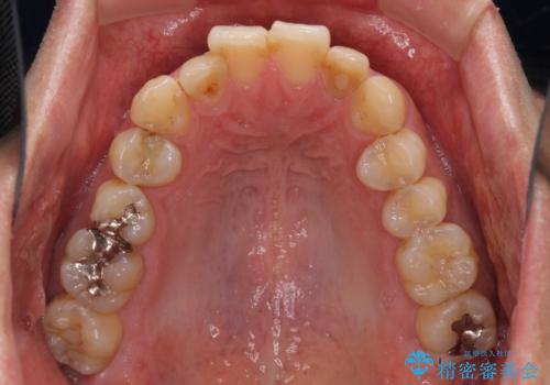前歯のデコボコと下顎の八重歯　インビザラインによる矯正治療の治療前