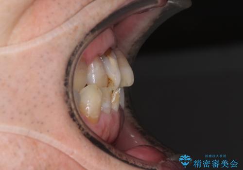 上顎の狭窄歯列 インビザラインによる拡大矯正の治療前