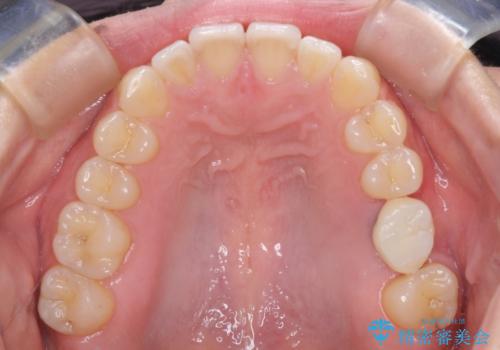 インプラントによる補綴治療とインビザライン矯正の治療中